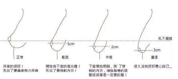 美莱胸部整形课堂|胸部下垂还能做假体隆胸吗