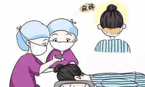 上海种植头发过程分为几个步骤?