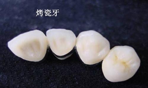 上海美莱做烤瓷牙|为什么做烤瓷牙要给牙齿“打桩”？