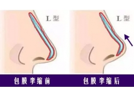 上海隆鼻假体都分几种?