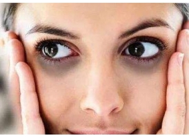 黑眼圈 | 三种类型，你属于哪种？
