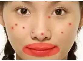 美莱祛痘如何，脸上长痘可以用激光治疗吗