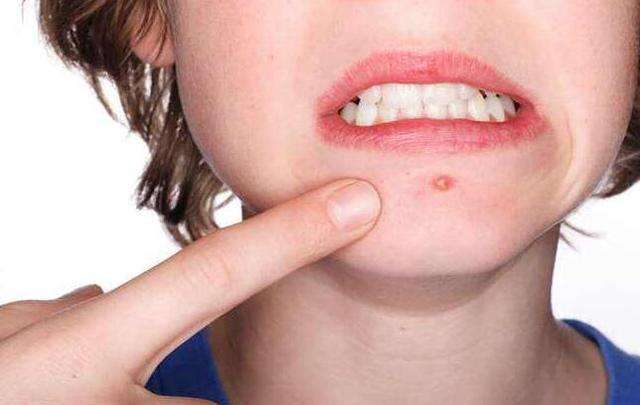 美莱祛痘如何，脸上长痘可以用激光治疗吗