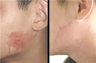 上海化学酸焕肤会使皮肤变薄吗?