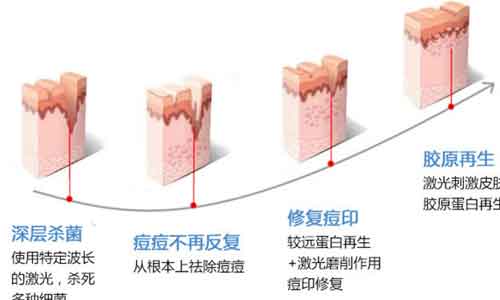 2年了我的痘印痘坑还在,该怎么办?美莱科普!