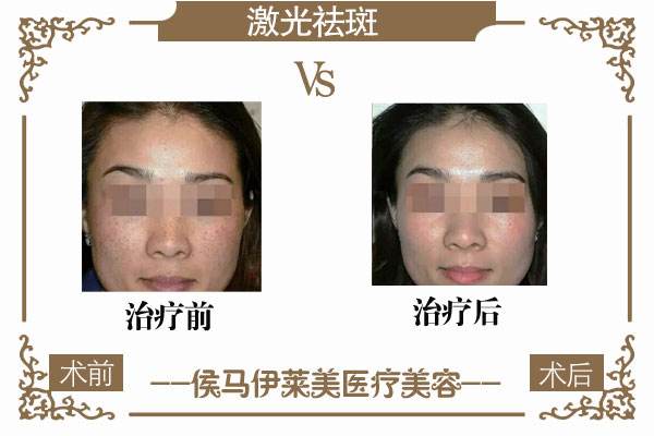 上海排名前十整形医院美莱怎样去除脸上的斑