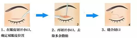 上海肿泡眼适合哪种双眼皮,不适合哪种双眼皮?