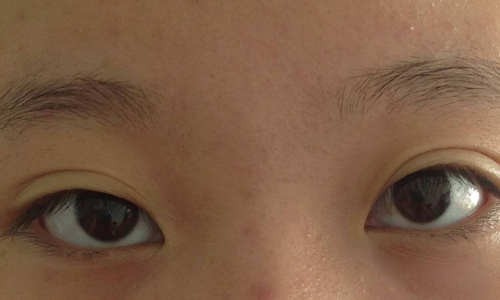 上海埋线双眼皮手术过程是怎样的?
