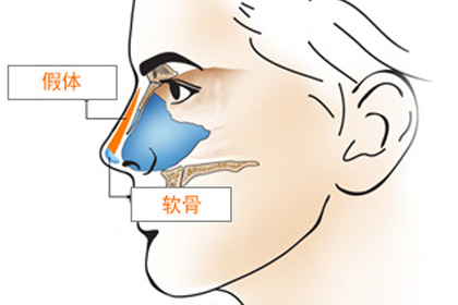 组织隆鼻，自体软骨手术优势有哪些
