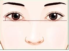 做了双眼皮失败后造成眼皮过宽再修复方法是什么