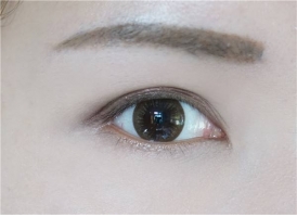 美莱韩式三点双眼皮能保持多长时间