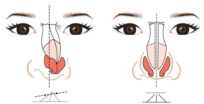上海隆鼻：耳软骨垫鼻尖和鼻中隔垫鼻尖有啥区别