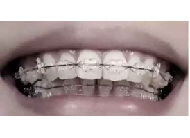 矫正牙齿会出现的问题会有哪些?美莱科普!