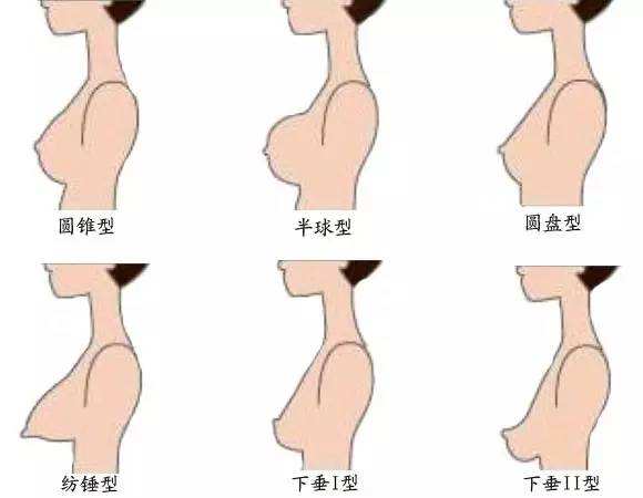 上海隆胸修复医院，整形隆胸修复要多少钱