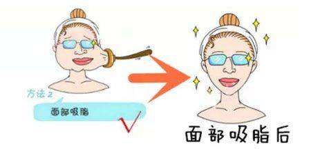 上海吸脂医院，面部吸脂瘦脸效果可以保持多长时间