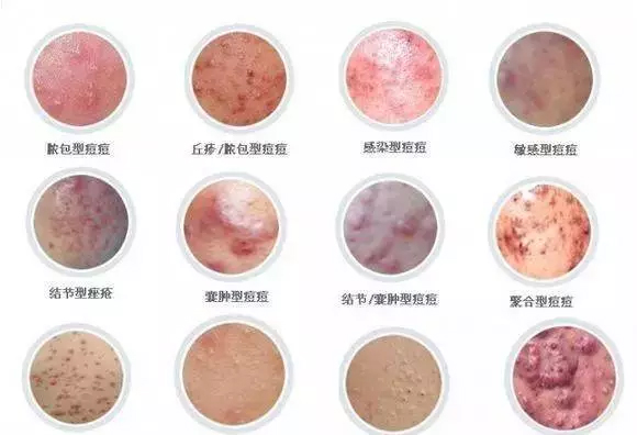 上海彩光嫩肤祛痘印要多少钱?