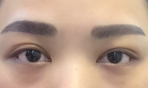 上海双眼皮大小眼怎么改善?