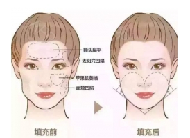 上海医院做自体脂肪填充脸部可以维持多久