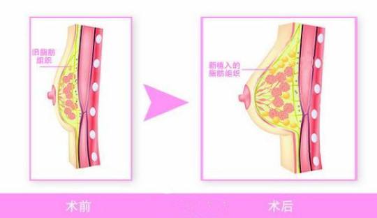 上海做了自体脂肪隆胸多久定型
