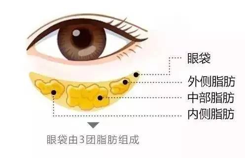 上海去眼袋手术能维持多久