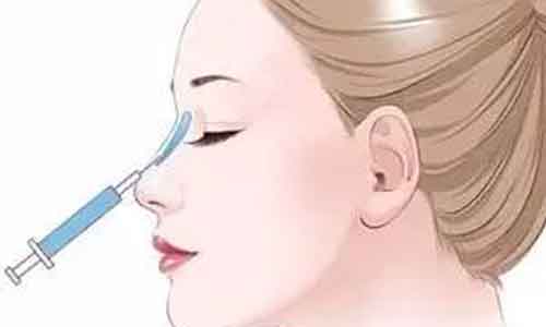 隆鼻玻尿酸能维持多久
