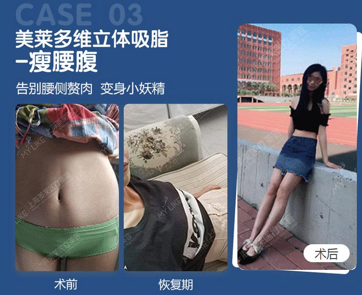 上海做抽脂减肥哪家医院效果好