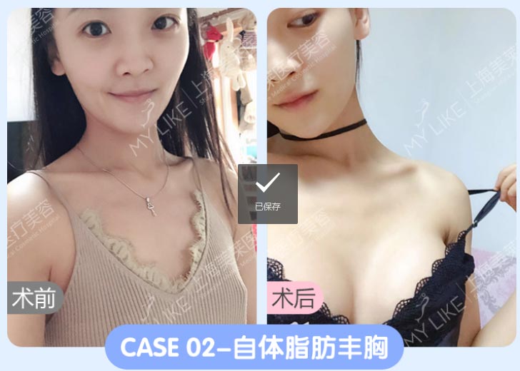上海美莱隆胸案例