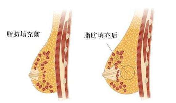 上海做自体脂肪丰胸手术哪家医院做得好些