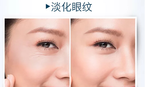 眼部皱纹怎么去除,上海美莱激光除皱可以去除