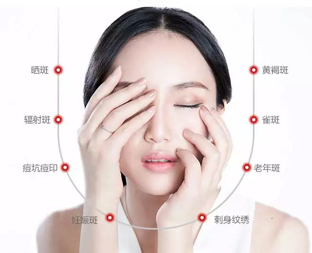 如何去除脸上色斑,上海美莱激光祛斑可以去除