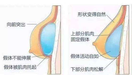 上海假体隆胸整形医院丰胸大概多少钱