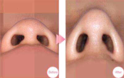 上海鼻子整形术价格鼻尖整形是多少