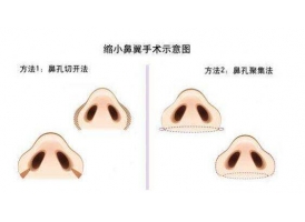 鼻翼缩小手术多少钱上海