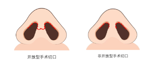 上海做综合鼻整形要多少钱