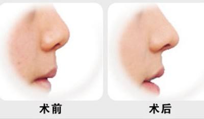 上海隆鼻，鼻子做好的好处有哪些