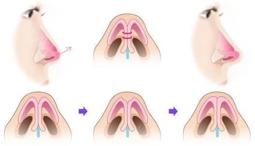 鼻头缩小手术会不会影响呼吸呢 