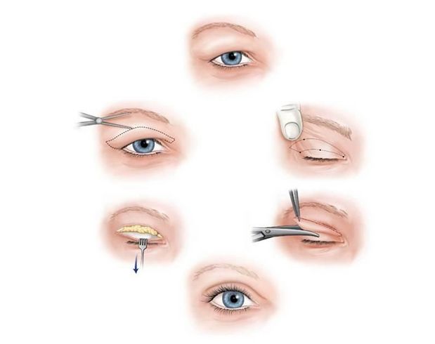 双眼皮手术埋线与全切切开选择哪种好
