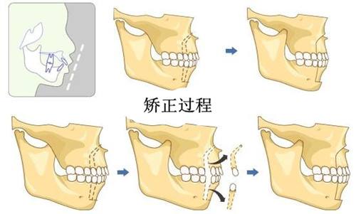 上海哪里做牙齿矫正比较好,什么样的适合