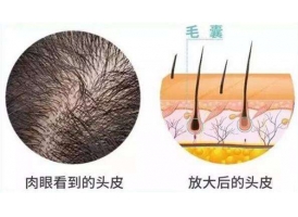 头发种植手术前后的注意事项有哪些