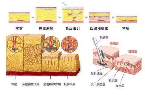 上海吸脂医院做腰腹环吸整形术费用一般是多少