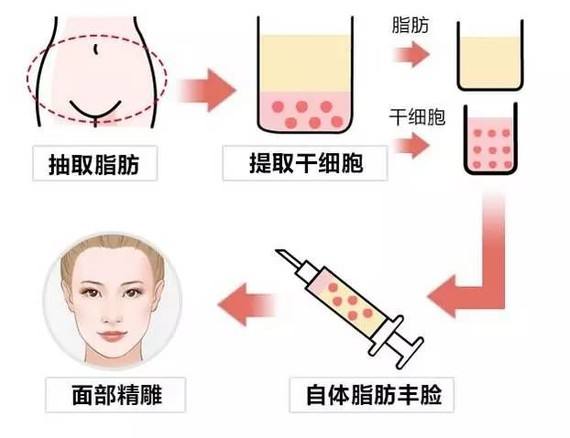 上海美莱做面部脂肪填充能维持多久