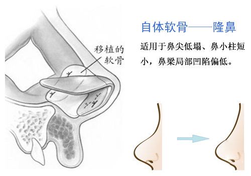 上海美莱：上海耳软骨隆鼻效果怎么样