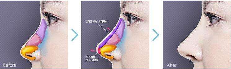 上海美莱: 隆鼻假体取出后鼻子会变形吗