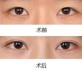 上海一般做眼部整形手术多少钱
