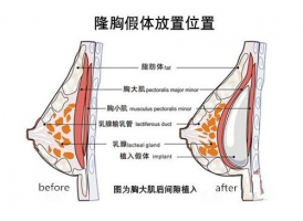 美莱汪灏:假体隆胸手术切口在哪里
