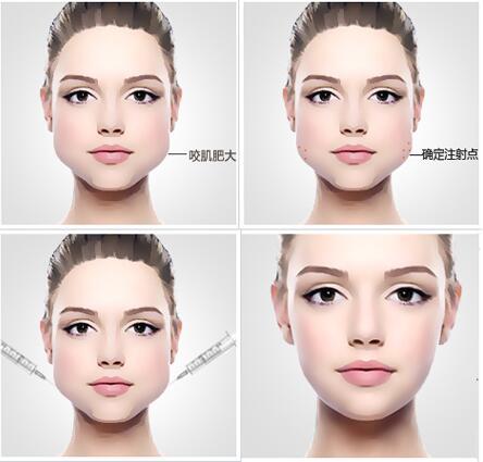 上海注射瘦脸美莱要打几次才能正式定型