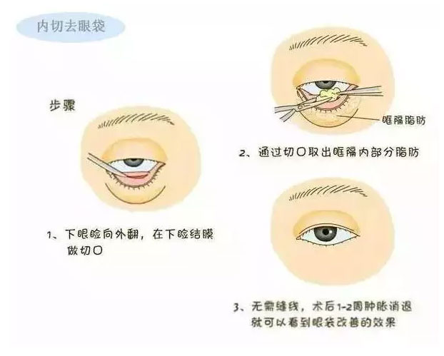 美莱何祥龙：卧蚕和眼袋的区别到底是什么