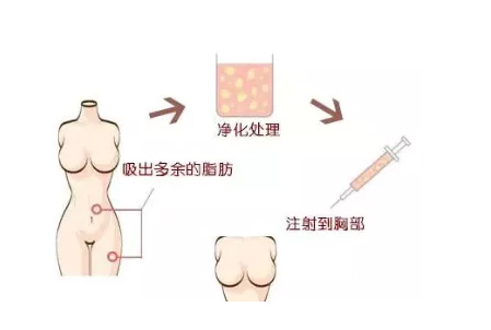 上海丰胸自体脂肪移植袁玉坤:什么才是完美胸型