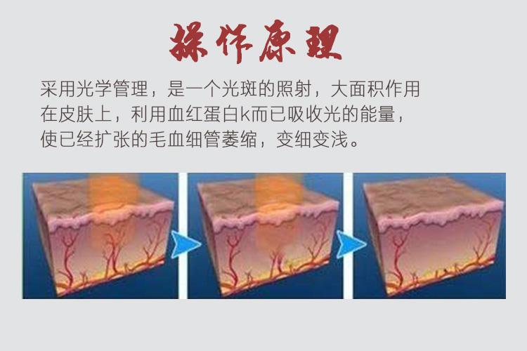 上海去除红血丝用激光消除需要多长时间