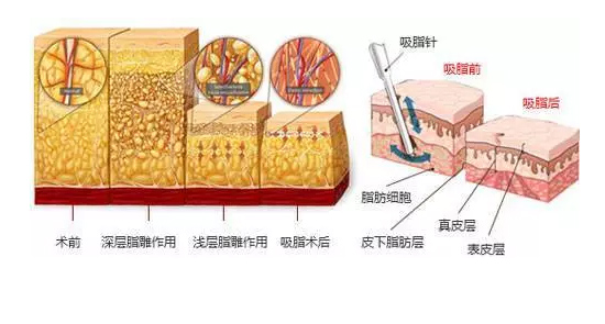上海做腿部吸脂对身体有什么影响